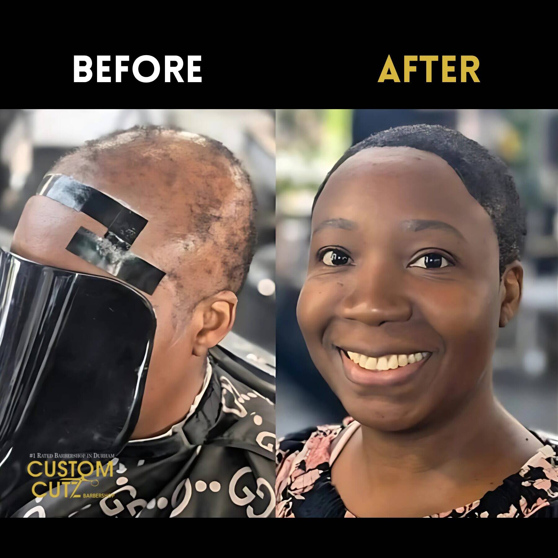 Close-up of hair replacement system on Oshawa client