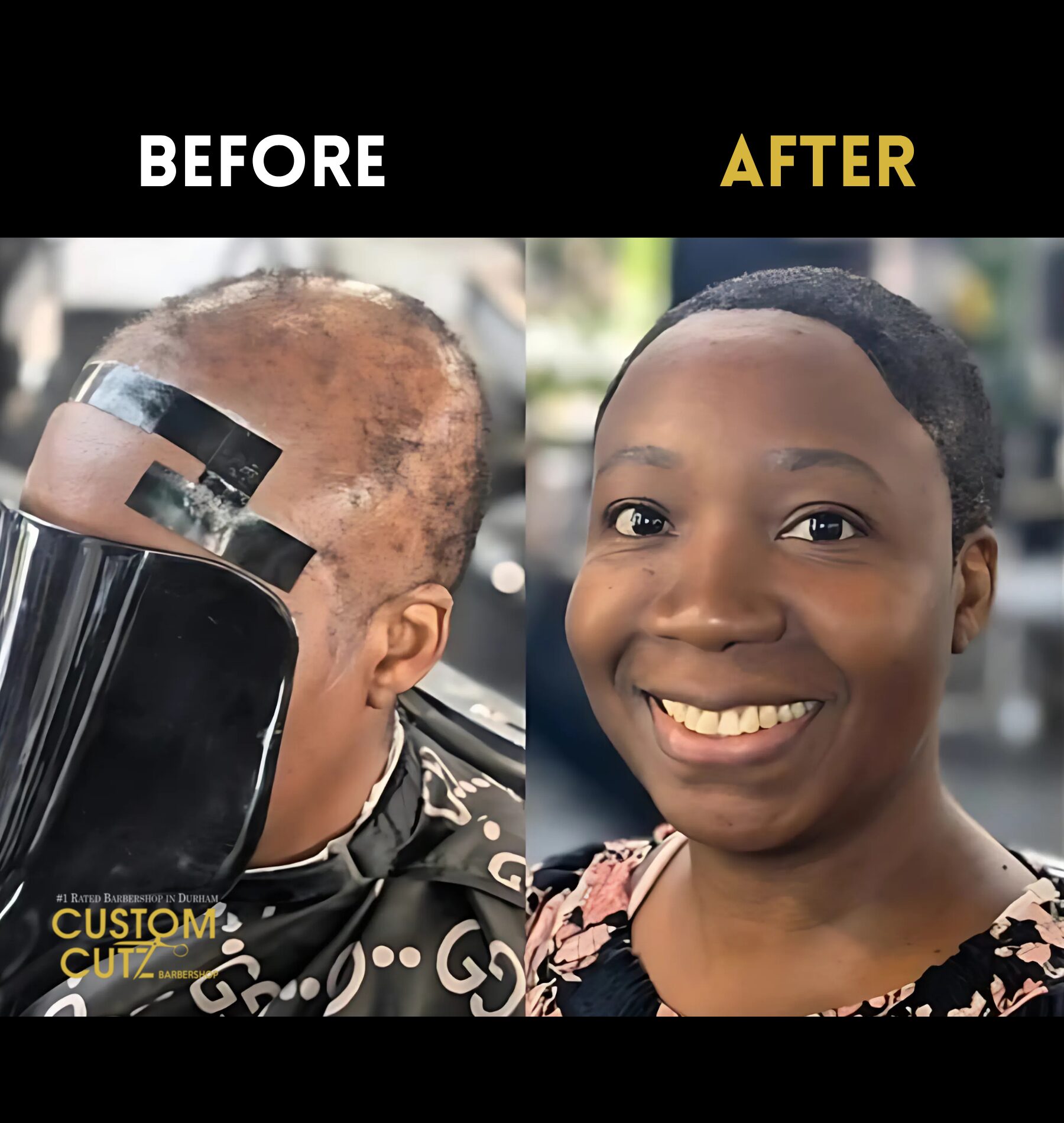 Close-up of hair replacement system on Oshawa client